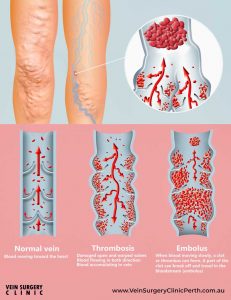 Thrombosis Vein Surgery Clinic Of Perth