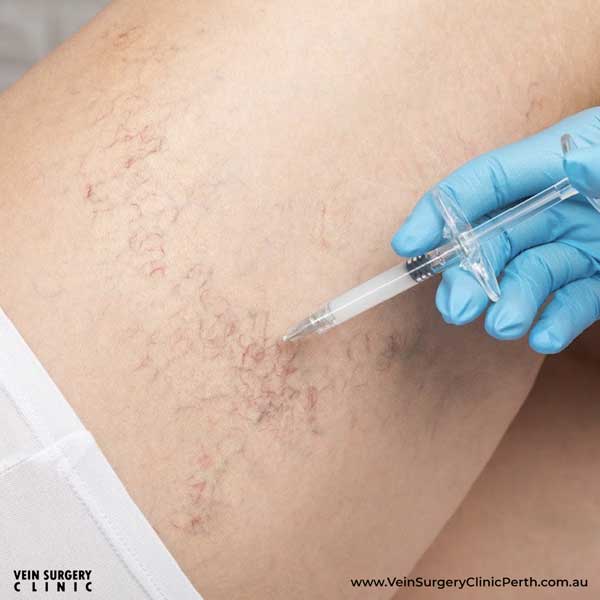 Sclerotherapy - Vein Surgery Clinic of Perth