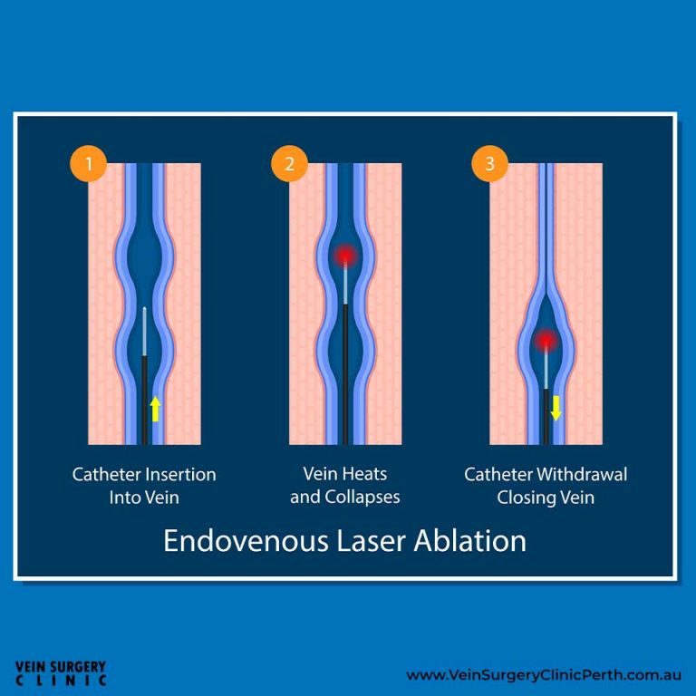 Endovenous laser ablation (EVLA) Vein Surgery Clinic of Perth