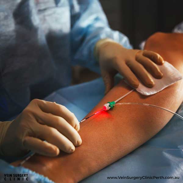 Endovenous laser ablation (EVLA) - Vein Surgery Clinic of Perth