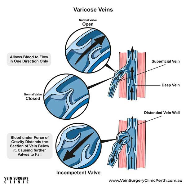 Superficial Veins Vs Deep Veins