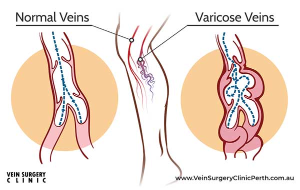 012-VARICOSE-VEIN-#002-V02