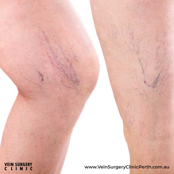 Spider Veins - Vein Surgery Clinic of Perth