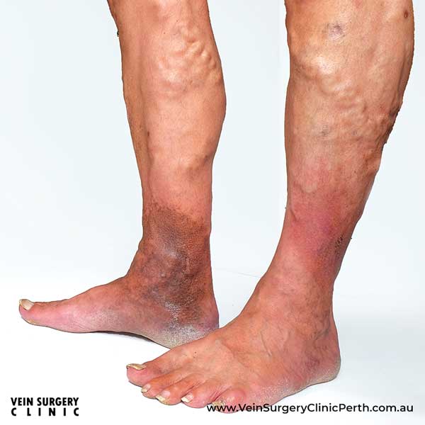 Chronic Venous Insufficiency - Cape Town Vascular