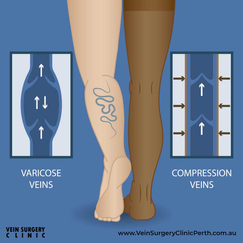 Compression therapy - Vein Surgery Clinic of Perth