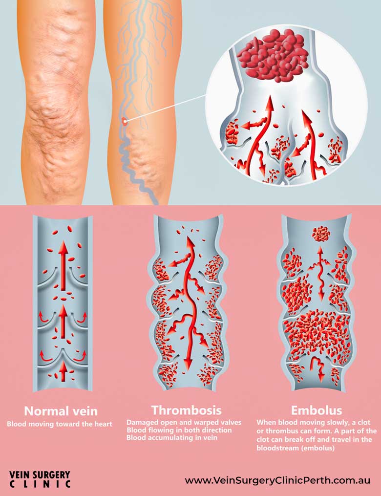 Wound care for blisters: discover the Leukoplast choices!